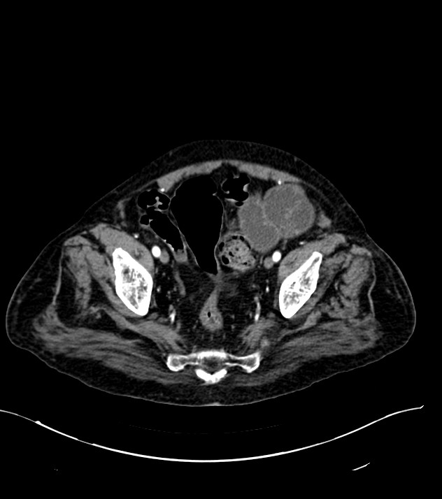 Cholangiocarcinoma with cerebral metastases (Radiopaedia 83519-98629 B 107).jpg