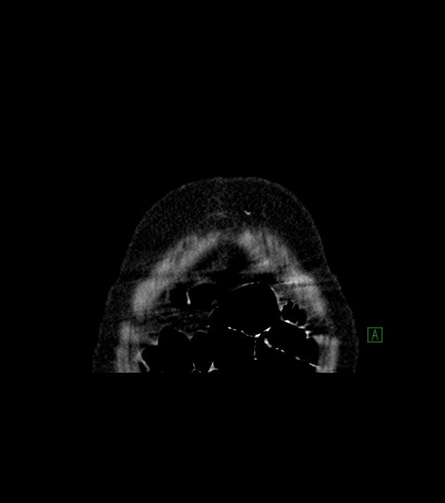 Cholangiocarcinoma with cerebral metastases (Radiopaedia 83519-98629 Coronal C+ delayed 1).jpg