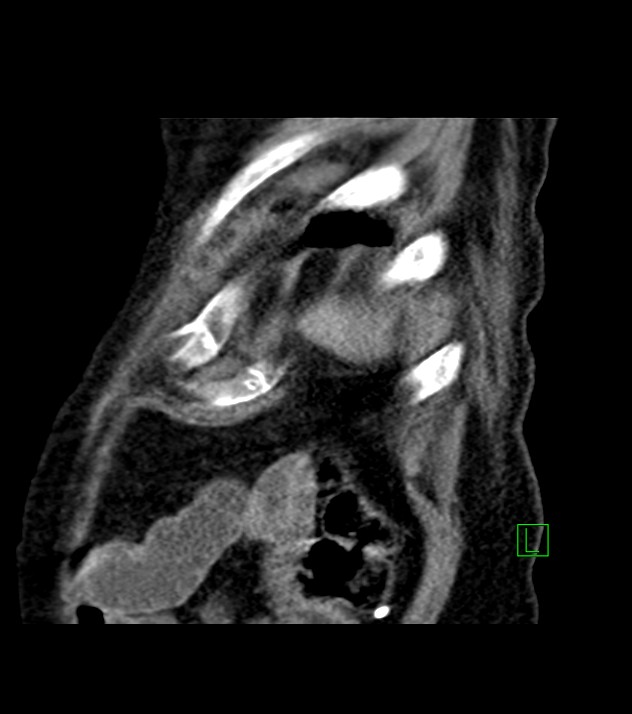 Cholangiocarcinoma with cerebral metastases (Radiopaedia 83519-98629 Sagittal C+ delayed 11).jpg