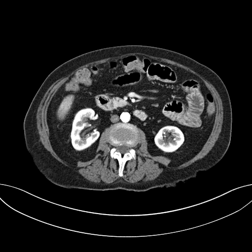 Cholecystoduodenal fistula due to calculous cholecystitis with gallstone migration (Radiopaedia 86875-103077 A 34).jpg