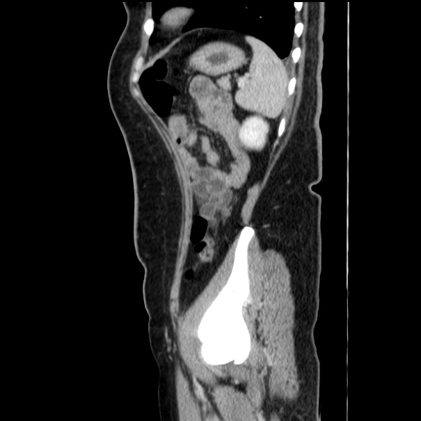 Choledocholithiasis on CT and MRI (Radiopaedia 24825-25087 D 50).jpg