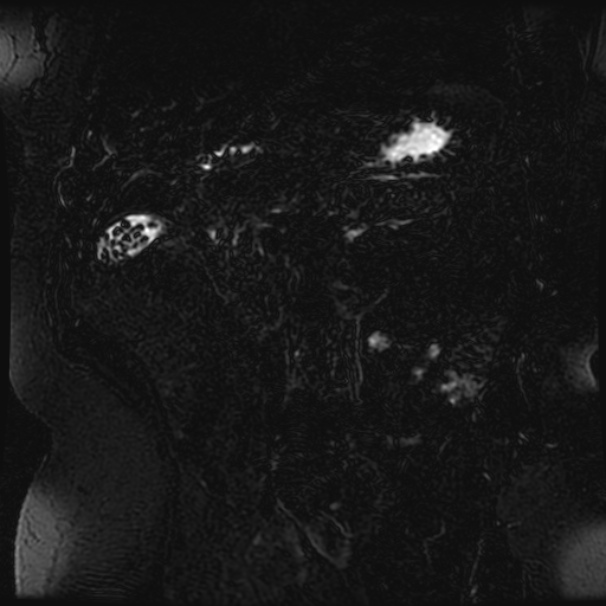Choledocholithiasis on CT and MRI (Radiopaedia 24825-25088 Coronal T2 54).jpg