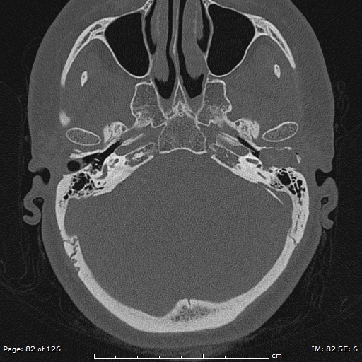 Cholesteatoma - external auditory canal (Radiopaedia 88452-105096 Axial bone window 45).jpg