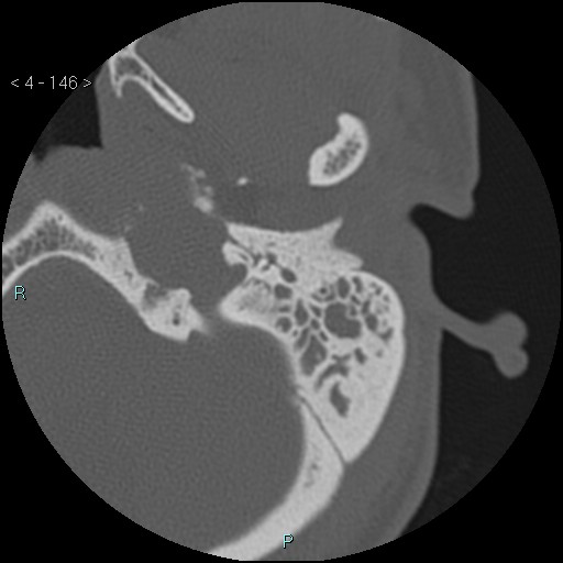 File:Cholesterol granuloma of the petrous apex (Radiopaedia 64358-73141 Axial bone window 70).jpg