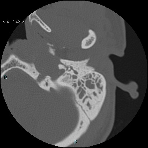 File:Cholesterol granuloma of the petrous apex (Radiopaedia 64358-73141 Axial bone window 72).jpg