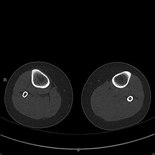 Chondroblastoma (Radiopaedia 62721-71030 Axial bone window 117).jpg