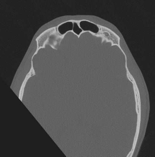 Chondrosarcoma (clivus) (Radiopaedia 46895-51425 Axial bone window 7).png