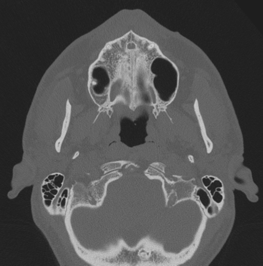 Chondrosarcoma (clivus) (Radiopaedia 46895-51425 Axial bone window 74).png