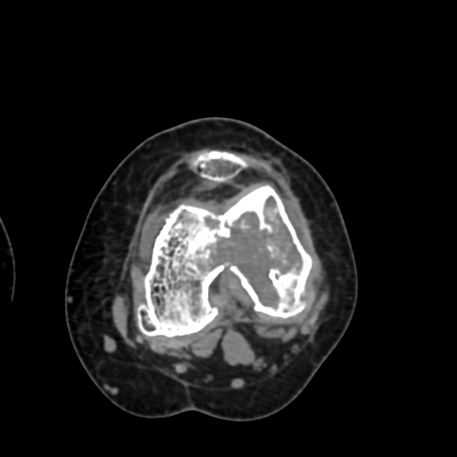 Chondrosarcoma - femur (Radiopaedia 64187-72954 Axial non-contrast 48).jpg