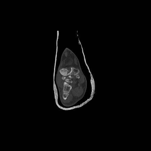 File:Chopart fracture (Radiopaedia 12386-12650 Coronal bone window 9).jpg