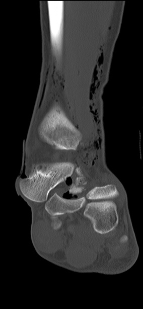 Chopart fracture (Radiopaedia 35347-36851 Coronal bone window 40).jpg