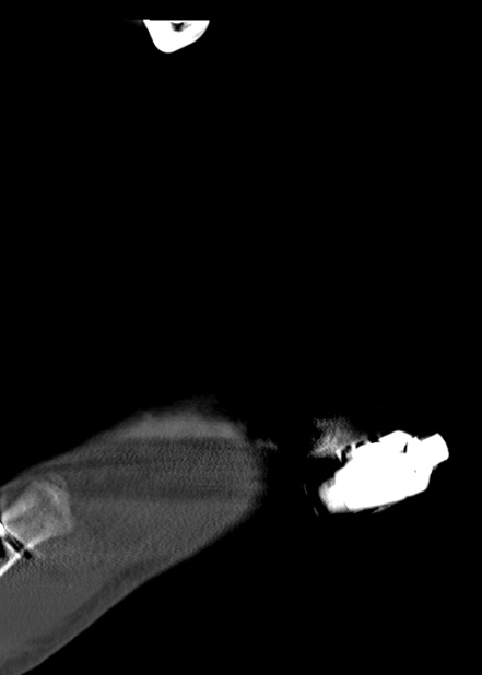 Chopart fracture (Radiopaedia 35347-36861 Sagittal bone window 22).jpg
