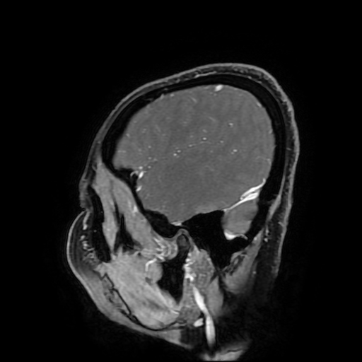 File:Chordoid glioma of third ventricle (Radiopaedia 91612-109340 F 169).jpg