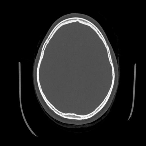 Choroid plexus papilloma extending into the cerebellopontine angle cistern (Radiopaedia 85941-101833 Axial bone window 66).png