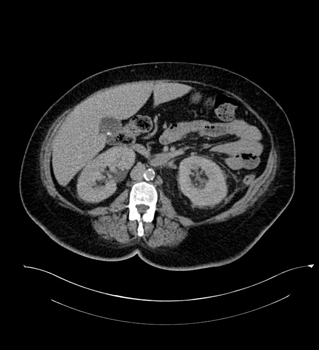 Chromophobe renal cell carcinoma (Radiopaedia 84239-99519 E 81).jpg