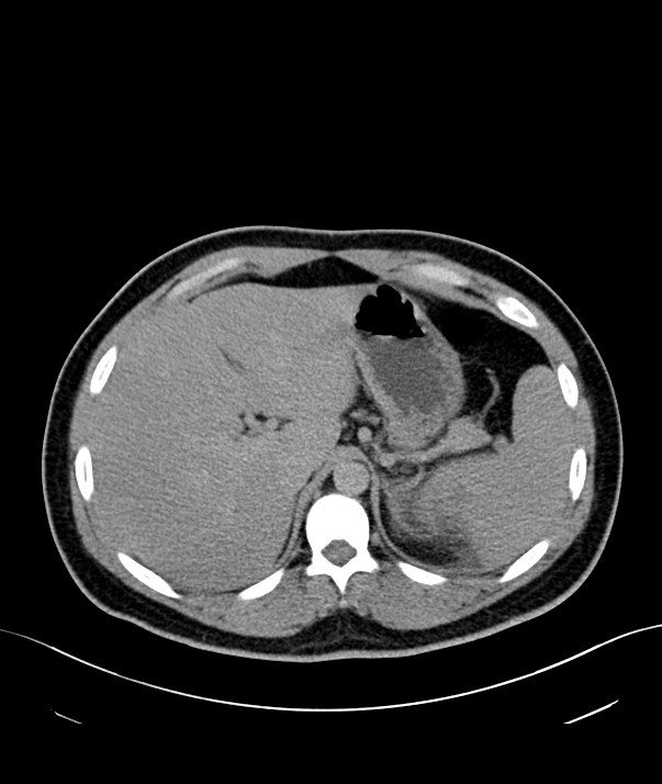 Chromophobe renal cell carcinoma (Radiopaedia 84255-99542 H 1).jpg