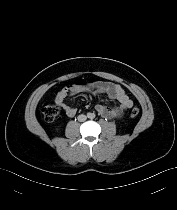 Chromophobe renal cell carcinoma (Radiopaedia 84255-99542 H 26).jpg