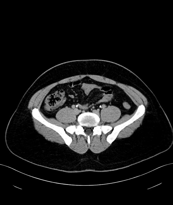Chromophobe renal cell carcinoma (Radiopaedia 84255-99542 H 40).jpg