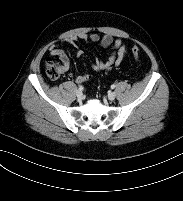 Chromophobe renal cell carcinoma (Radiopaedia 84286-99573 G 55).jpg
