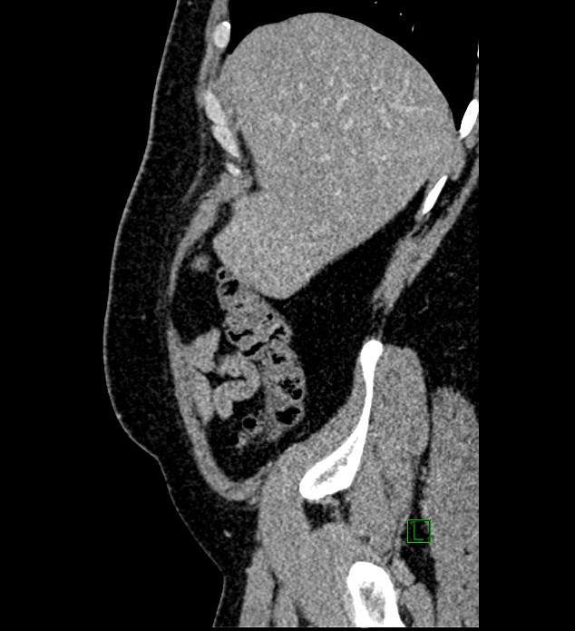 Chromophobe renal cell carcinoma (Radiopaedia 84286-99573 I 161).jpg