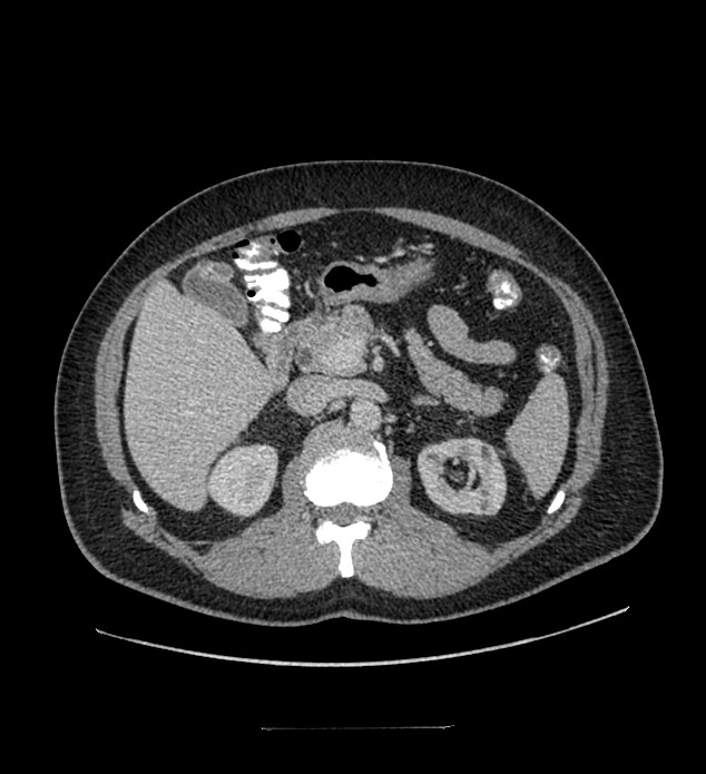 Chromophobe renal cell carcinoma (Radiopaedia 84337-99644 C 47).jpg