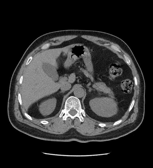 Chromophobe renal cell carcinoma (Radiopaedia 86879-103083 Axial non-contrast 19).jpg