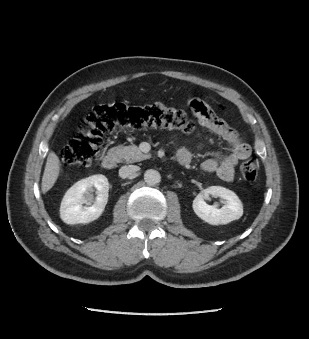 Chromophobe renal cell carcinoma (Radiopaedia 86879-103083 C 59).jpg