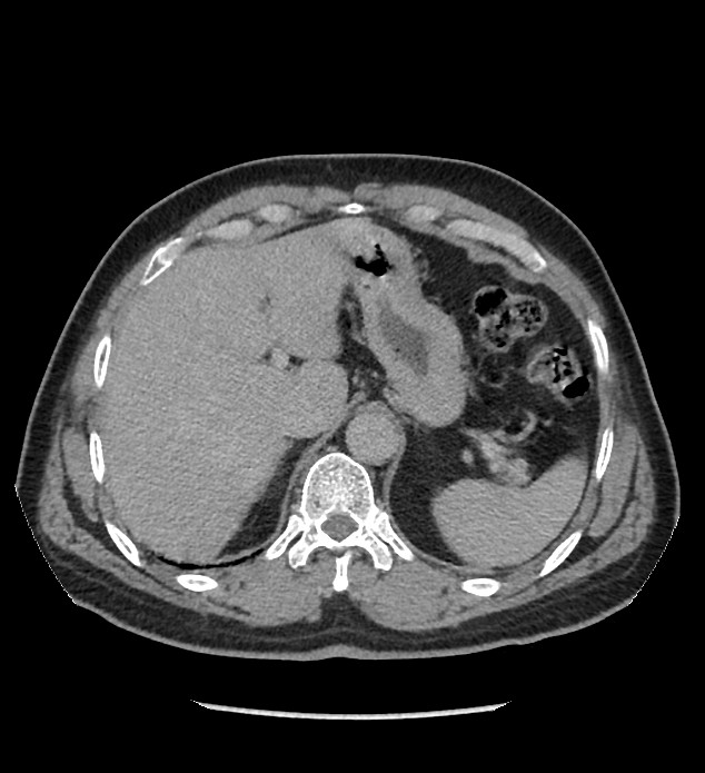 Chromophobe renal cell carcinoma (Radiopaedia 86879-103083 D 27).jpg