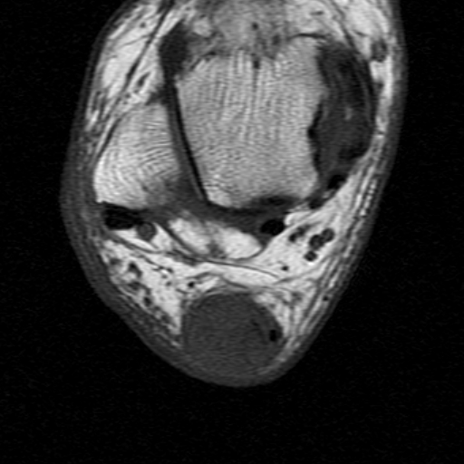 File:Chronic Achilles tendon rupture (Radiopaedia 15262-15100 Axial T1 15).jpg