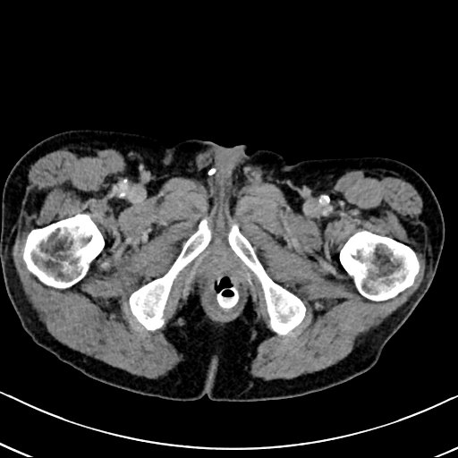 Chronic appendicitis complicated by appendicular abscess, pylephlebitis and liver abscess (Radiopaedia 54483-60700 B 154).jpg