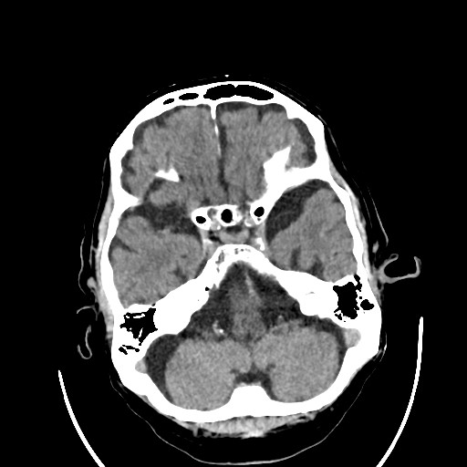 Chronic bilateral subdural hygroma (Radiopaedia 85801-101622 Axial non-contrast 32).jpg