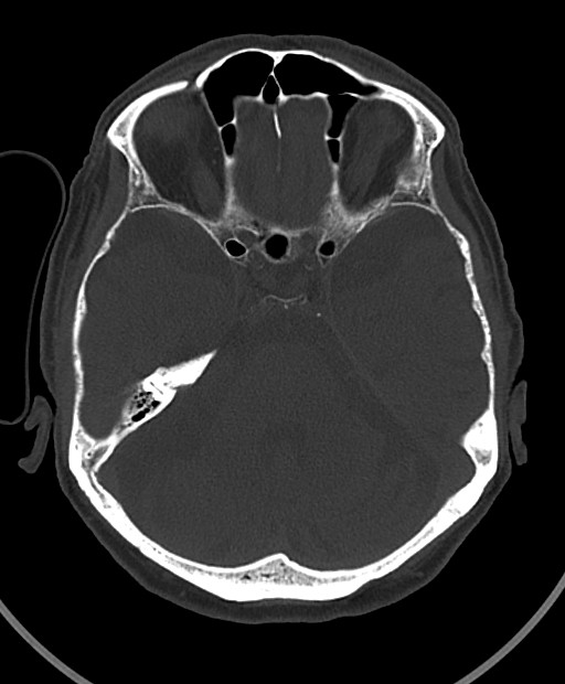Chronic bilateral subdural hygroma (Radiopaedia 85801-101623 Axial bone window 85).jpg