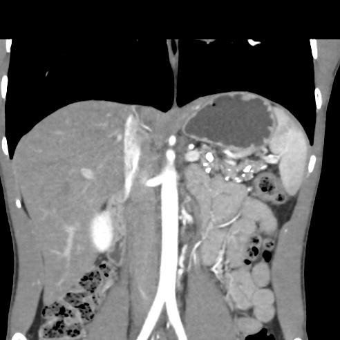 File:Chronic calcific pancreatitis (Radiopaedia 56280-62953 E 14).jpg