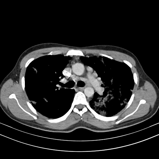 Chronic eosinophilic pneumonia (Radiopaedia 39331-41587 Axial C+ delayed 46).png
