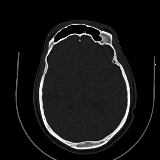 Chronic invasive fungal sinusitis (Radiopaedia 91563-109286 Axial sinus 140).jpg
