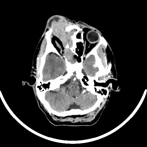 Chronic invasive fungal sinusitis with intraorbital and intracranial extension (Radiopaedia 56387-63046 B 102).jpg
