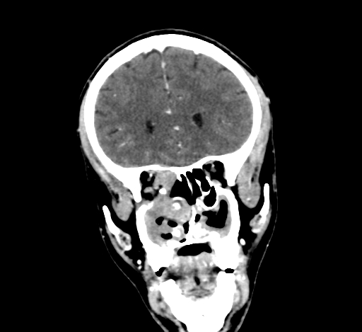 Chronic invasive fungal sinusitis with intraorbital and intracranial extension (Radiopaedia 56387-63046 C 124).jpg