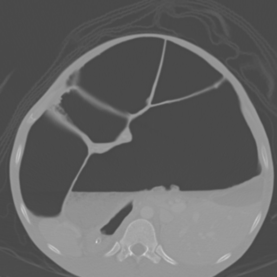 File:Chronic large bowel pseudo-obstruction (Radiopaedia 43181-46492 Axial bone window 67).jpg