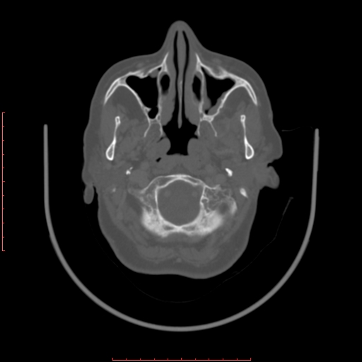 Chronic osteomyelitis - maxilla (Radiopaedia 23783-23927 Axial bone window 108).jpg