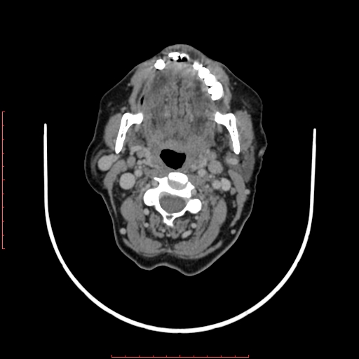 File:Chronic osteomyelitis - maxilla (Radiopaedia 23783-23927 B 29).jpg