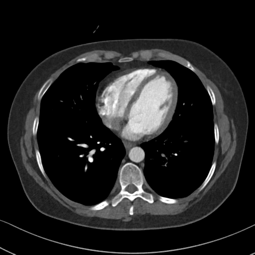 Chronic pulmonary embolus (Radiopaedia 39129-41341 Axial C+ CTPA 68).png