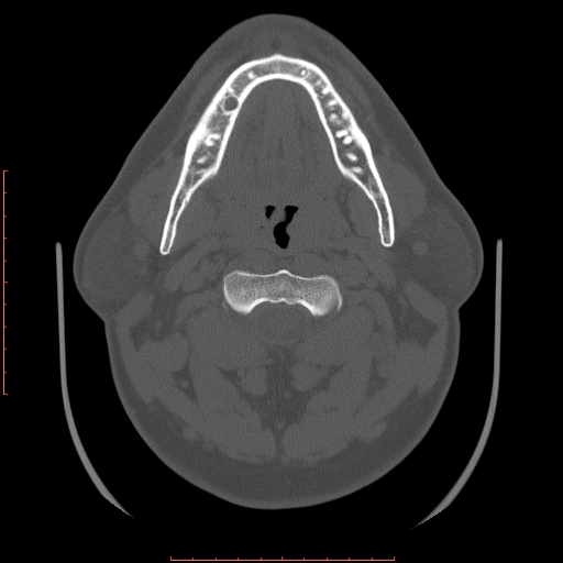 Chronic submandibular sialolithiasis (Radiopaedia 69817-79814 Axial bone window 52).jpg