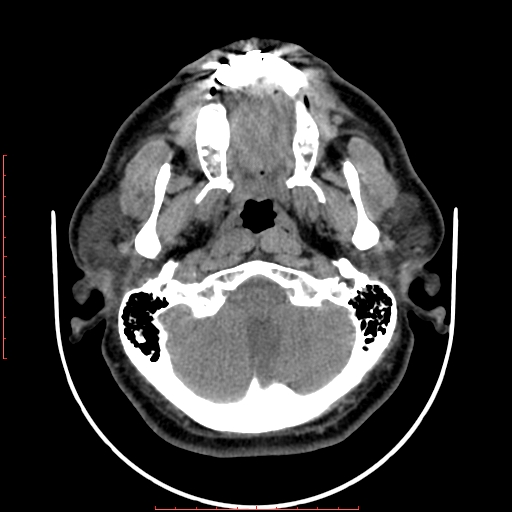 Chronic submandibular sialolithiasis (Radiopaedia 69817-79814 Axial non-contrast 35).jpg