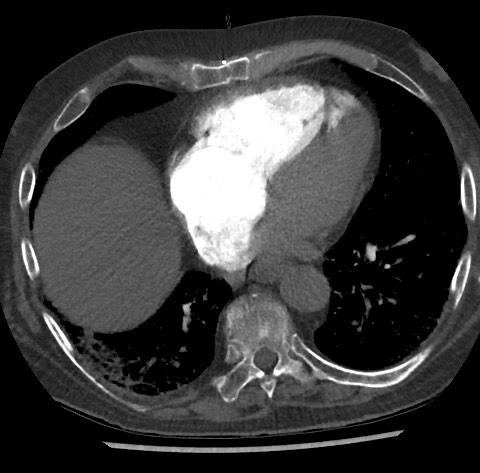 File:Chronic thromboembolic pulmonary disease (Radiopaedia 90694-108119 Axial C+ CTPA 67).jpg