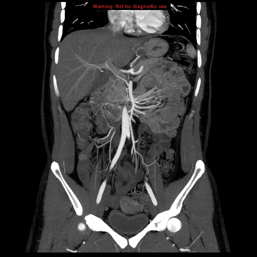 File:Circumaortic left renal vein (Radiopaedia 9069-9792 B 12).jpg