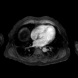 Cirrhosis and hepatocellular carcinoma in the setting of hemochromatosis (Radiopaedia 75394-86594 Axial T1 C+ fat sat 256).jpg