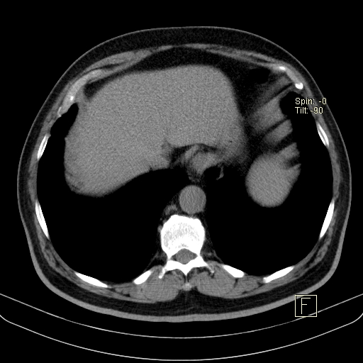 File:Classic complicated silicosis (Radiopaedia 49720-54961 Axial liver window 48).jpg