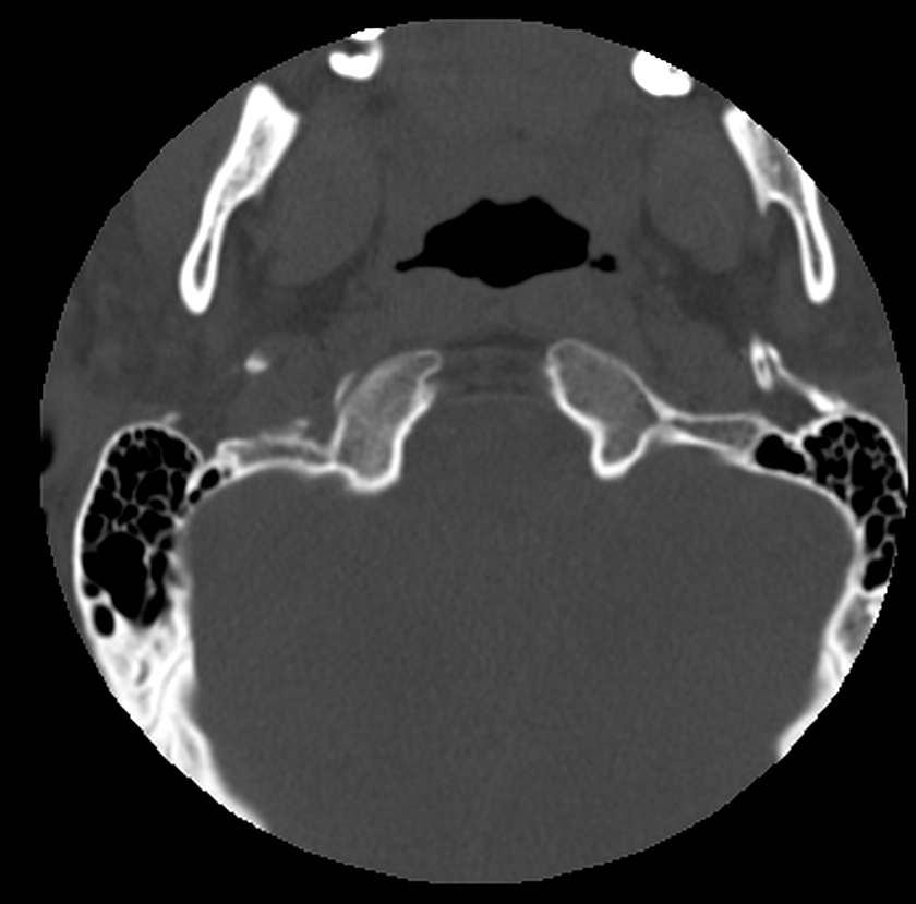 Clay-shoveler fracture (Radiopaedia 22568-22590 Axial bone window 2).jpg