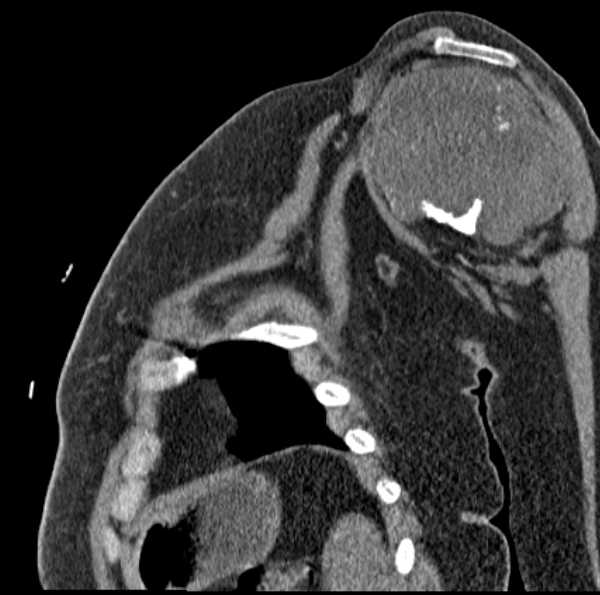 Clear cell chondrosarcoma - humerus (Radiopaedia 63104-71612 D 29).jpg