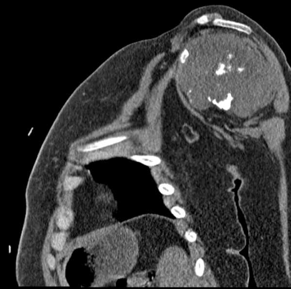 File:Clear cell chondrosarcoma - humerus (Radiopaedia 63104-71612 D 30).jpg